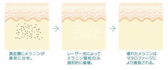 レーザー照射時の図