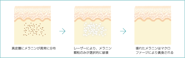 レーザー照射時(イメージ図)