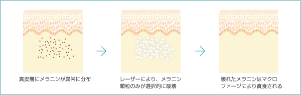 レーザー照射時(イメージ図)